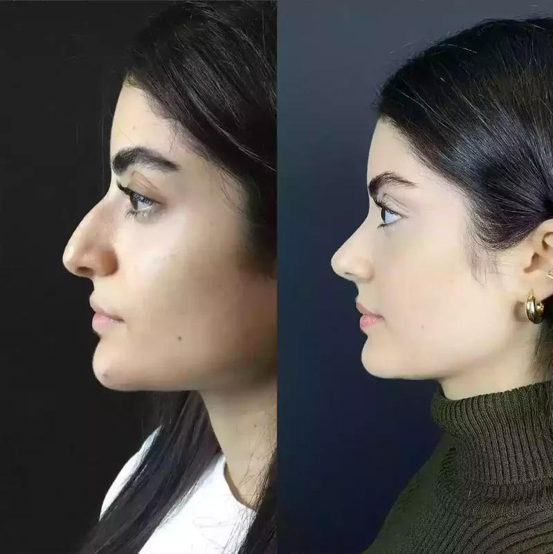 Rhinoplasty in Dubai: A Guide to Top Surgeons and Clinics