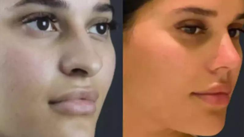 Best Doctors in Dubai for Rhinoplasty: Achieving a Perfectly Balanced Nose