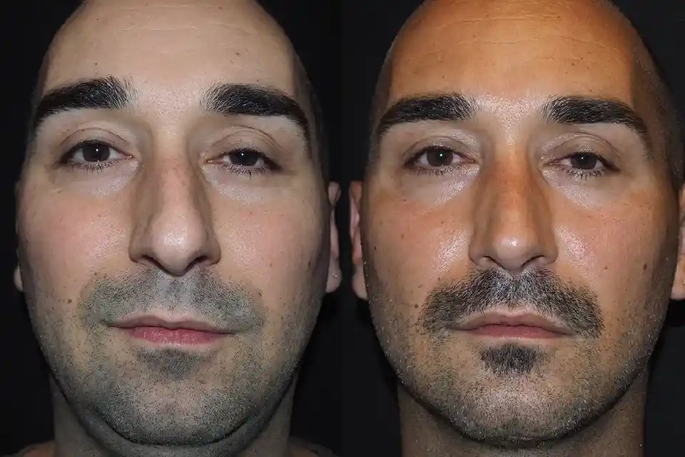 Rhinoplasty in Dubai: Best Options for Men