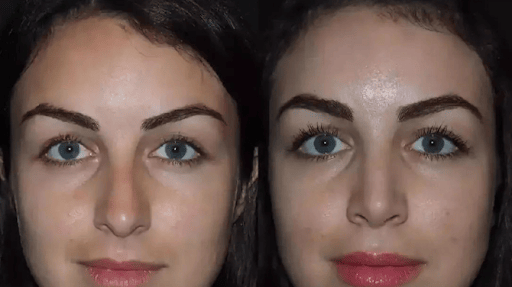 Nose Surgery in Dubai: A Trusted Choice for Aesthetic Care