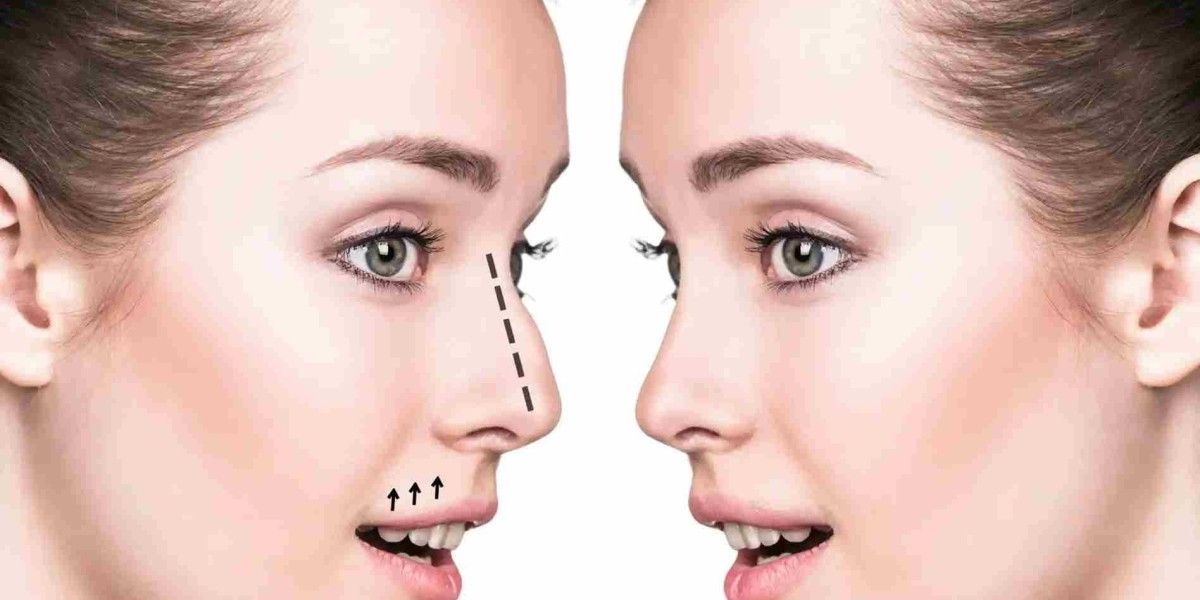 Rhinoplasty in Dubai: Complete Guide to Modern Nose Surgery